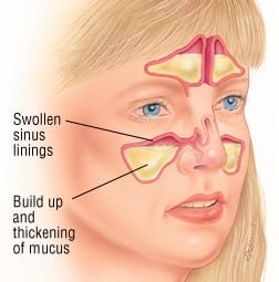 Scientific illustration of sinusitis location and symptoms