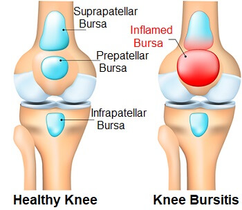 Scientific illustration of a comparison between a healthy knee and one with bursitis
